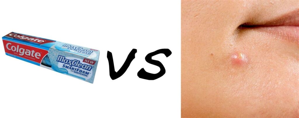 does toothpaste remove pimples